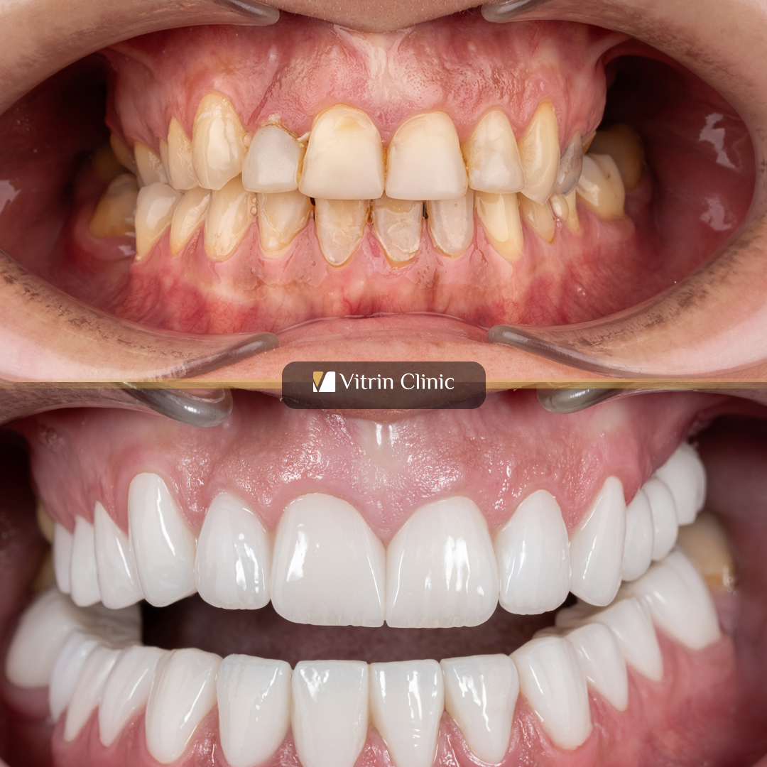 Full Mouth Dental Crowns in Turkey: Cost, Materials, Process & Results